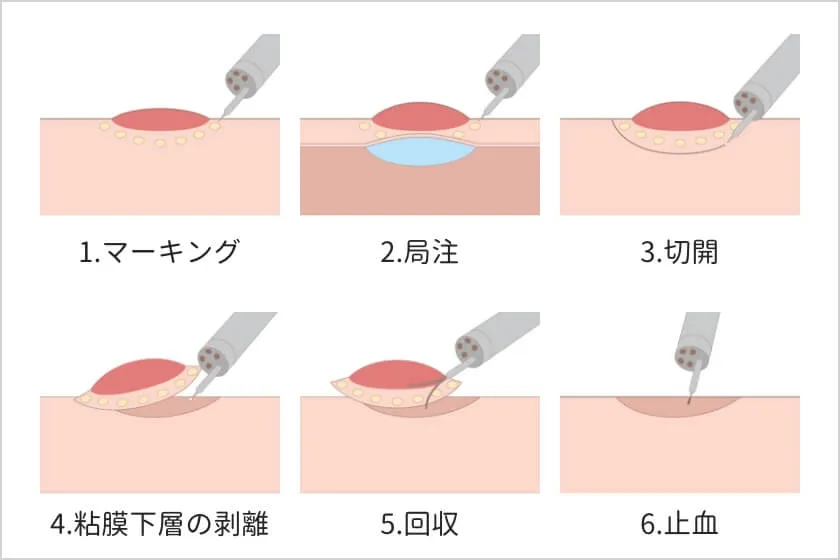 内視鏡的粘膜下層剥離術 (ESD) イメージ