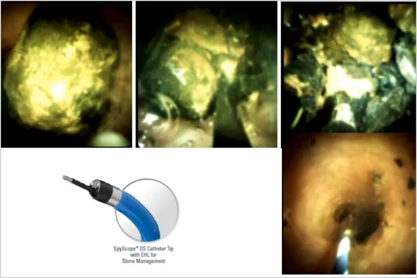 胆道鏡 (SpyGlassDS) と電気水圧衝撃波 (EHL) を併用した総胆管結石の破砕術 イメージ