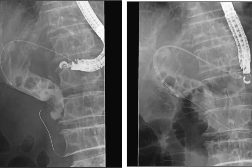 EUS-BD (超音波内視鏡下胆道ドレナージ) イメージ