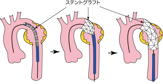 下行大動脈瘤に対するステントグラフト内挿術