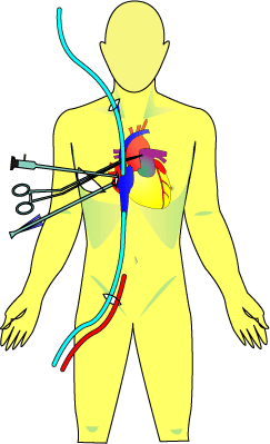 Minimally Invasive Cardiac Surgery