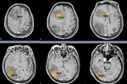 脳転移に対する多標的同時定位照射