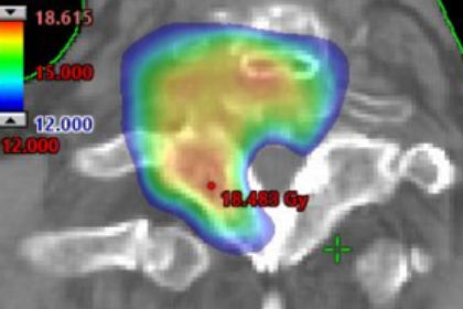 脊椎転移に対する脊髄打ち抜き脊椎定位照射