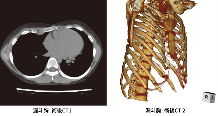 漏斗胸 イメージ