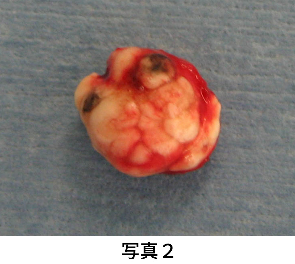 石灰化上皮腫 イメージ