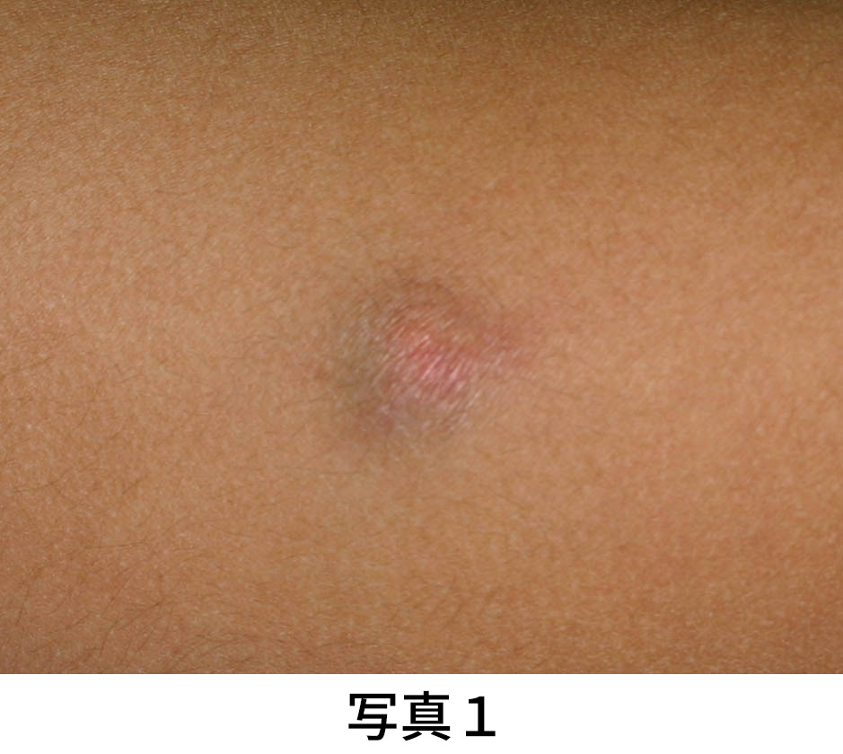 石灰化上皮腫 イメージ
