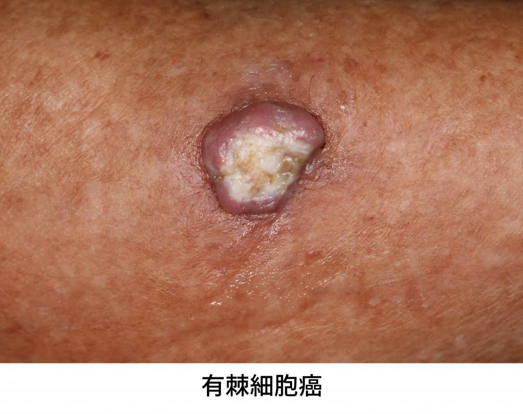 有棘細胞癌 イメージ