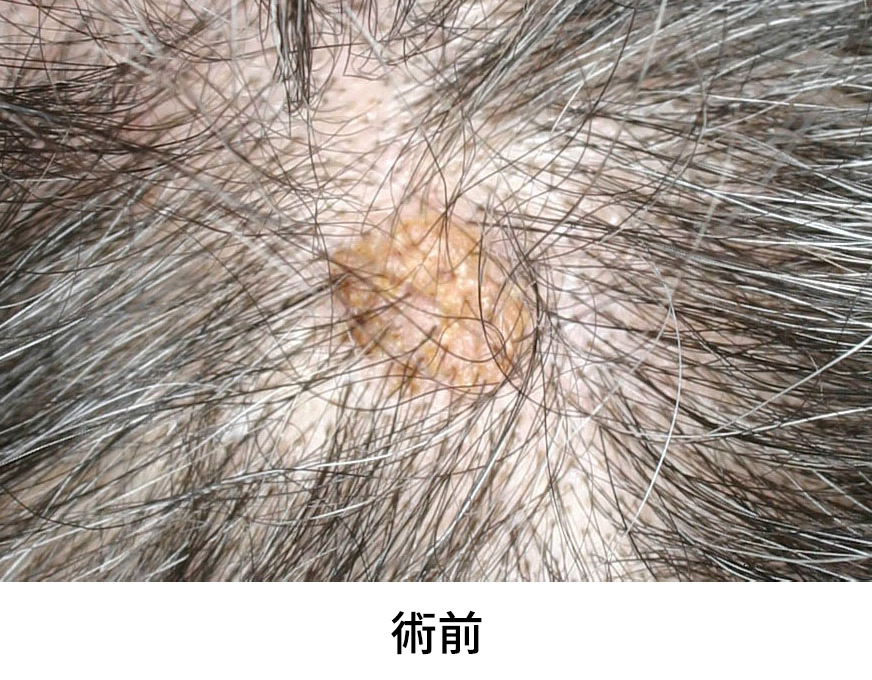 脂漏性角化症 イメージ