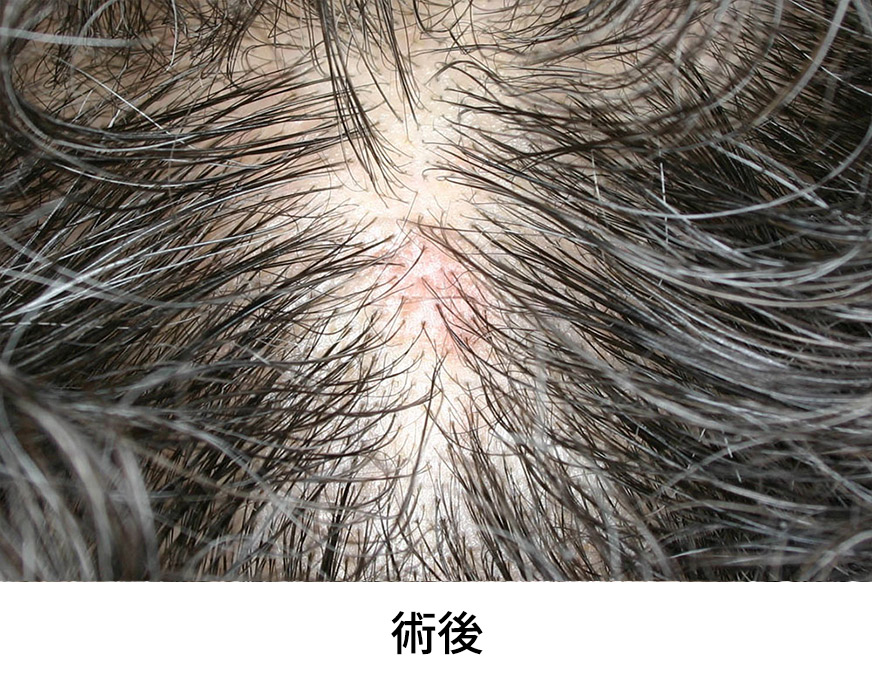 脂漏性角化症 イメージ