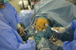 腹腔鏡下肝切除の手術
