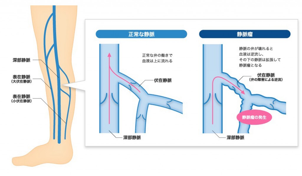 下肢静脈瘤発症の仕組み