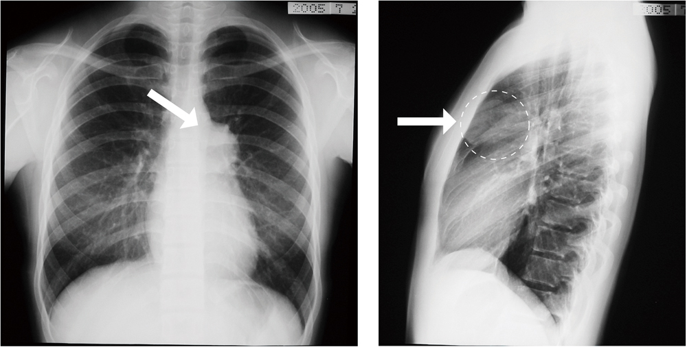 胸部X線写真（正面・側面）
