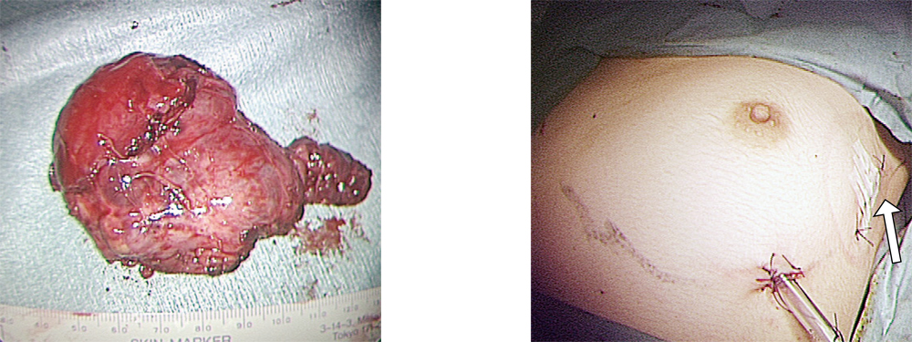 左：腫瘍の内部には骨、白髪、膵組織，神経組織を認めた、右：左乳房外縁に沿った4cmの傷で手術