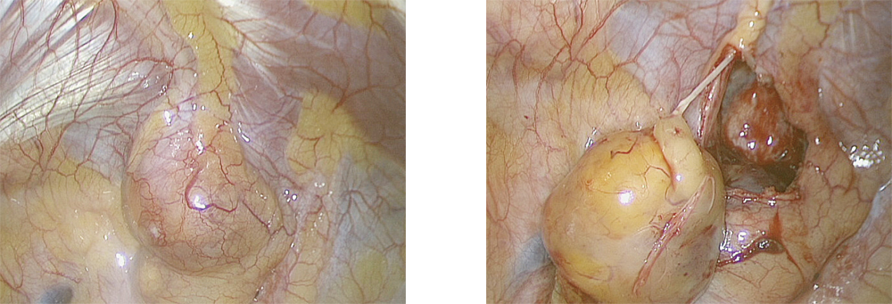 左：胸腔内所見（後縦隔腫瘍）、右：胸壁から剥離した腫瘍