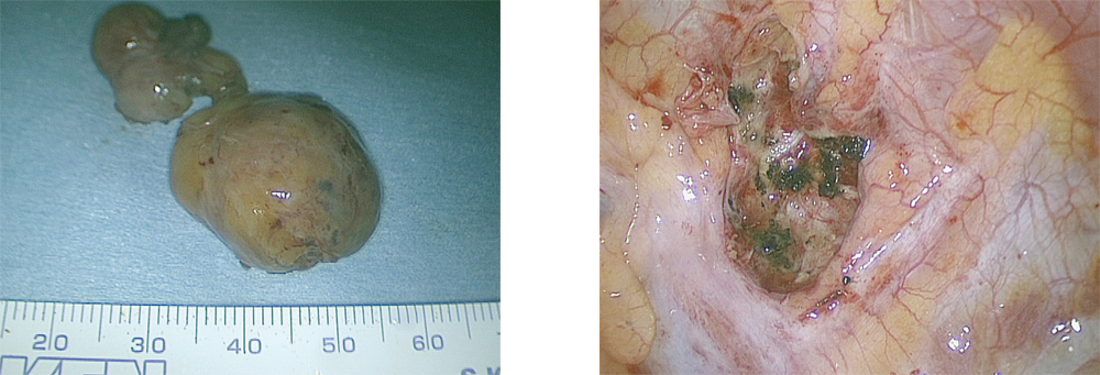 左：摘出した2個の連なる腫瘍、右：腫瘍摘出後胸腔内所見