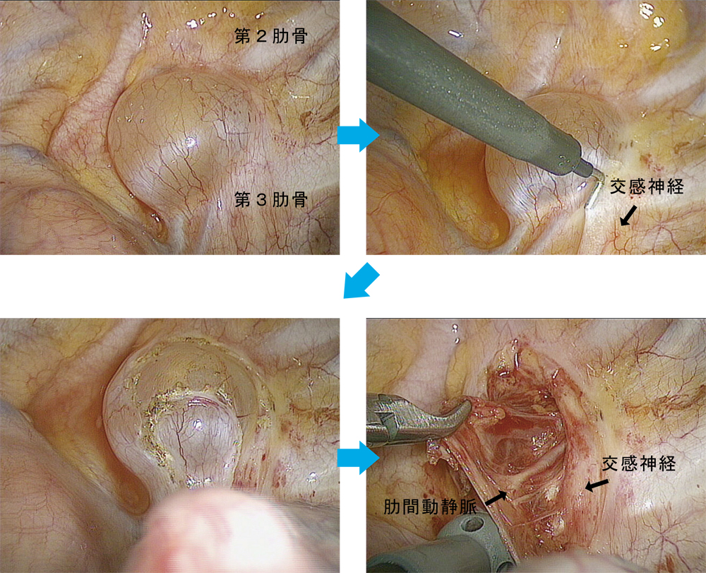 左上：嚢腫は第2肋骨と第3肋骨に存在、右上：壁側胸膜を切開、左下：壁側胸膜を切離した嚢腫壁を露出、右下：切除後の胸腔内所見
