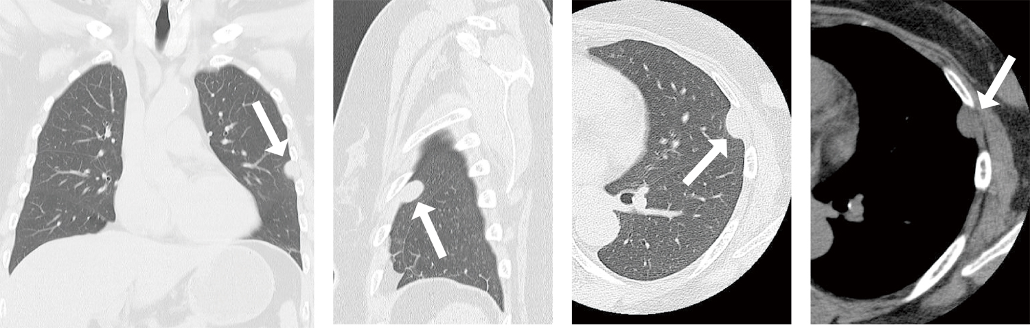 胸部CT（正面・左側面・肺野条件・縦隔条件）