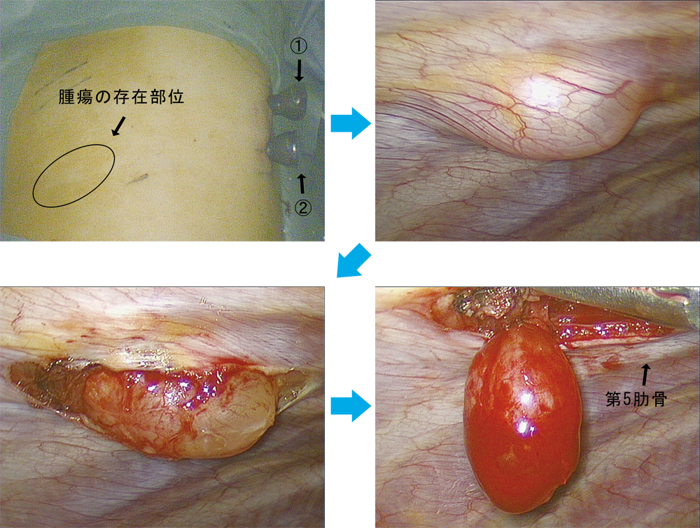 左上：2port methood ①②で手術を開始、右上：第5肋間に楕円形の腫瘍を認める、左下：腫瘍を壁側胸膜から剥離・露出、右下：腫瘍の全貌