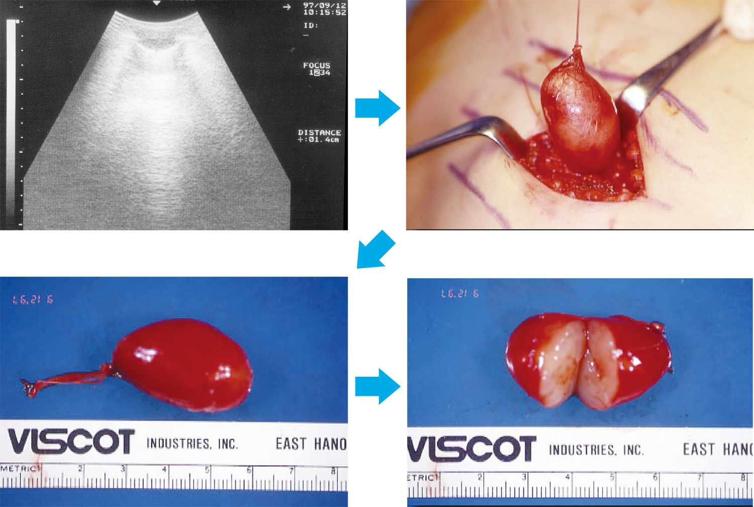 左上：エコーで腫瘍の部位を確認、右上：局所麻酔下に腫瘍を体表から摘出、左下：摘出した腫瘍、右下：腫瘍の割面