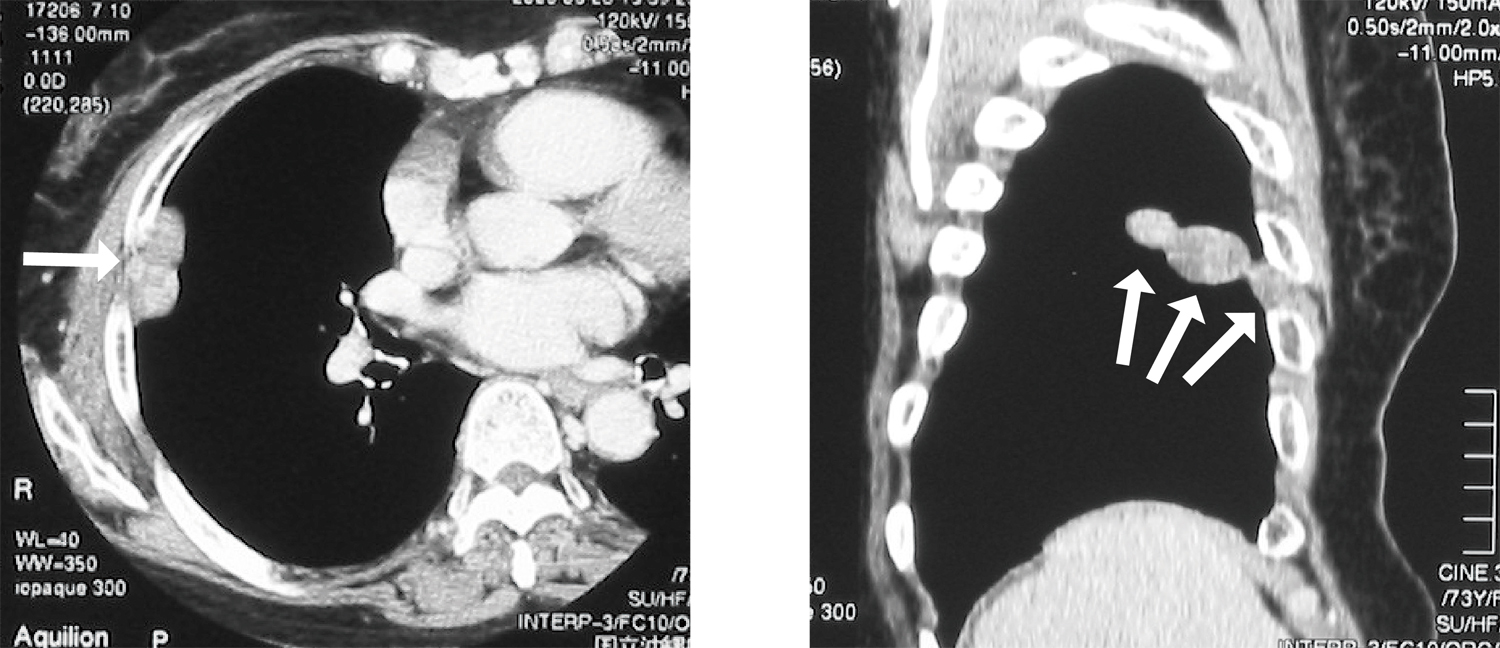 左：胸部CT（水平断）、右：胸部CT（矢状断）