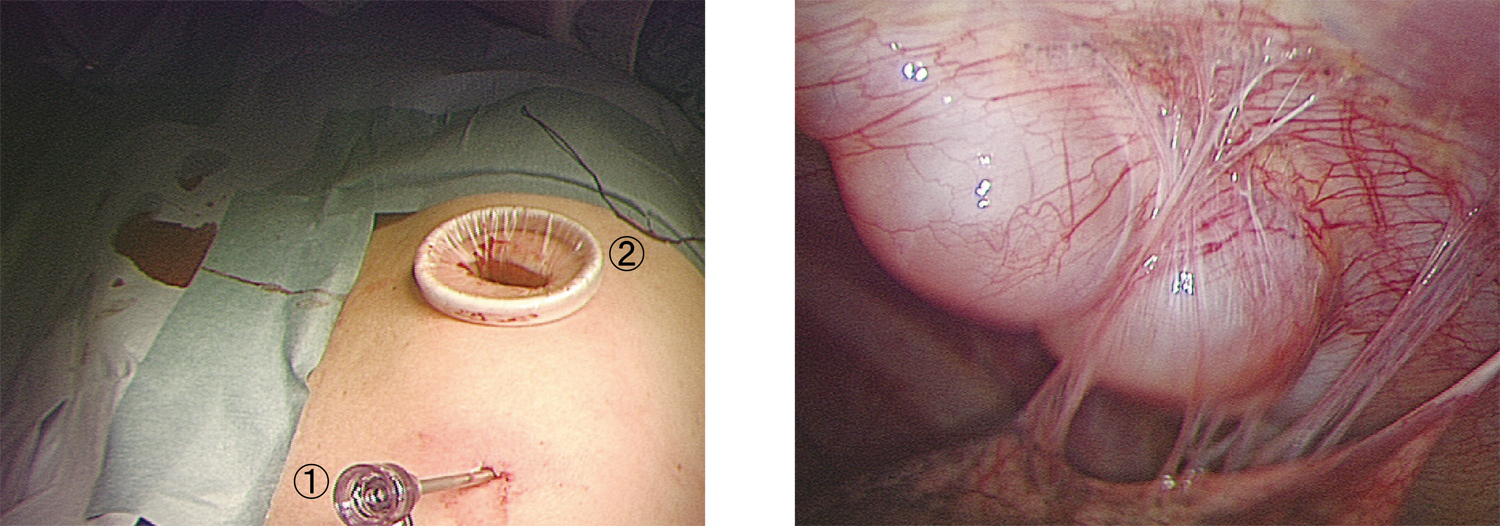左：カメラ孔①とミニ開胸部位②から手術、右：胸腔内に突出する胸壁腫瘍
