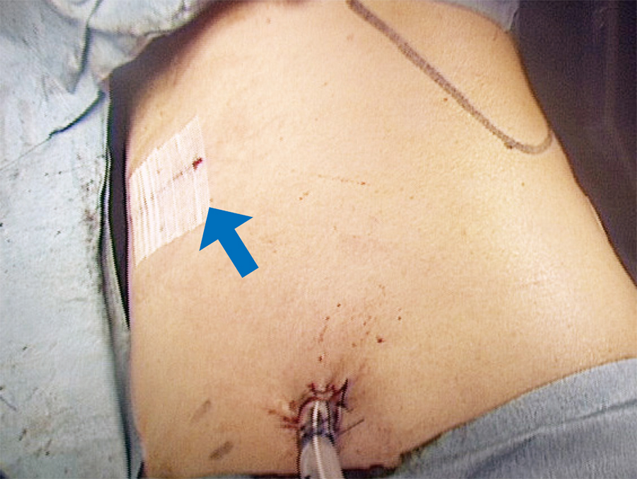 淺村・呼吸器外科手術 【中古-非常に良い】 淺村・呼吸器外科手術 淺村・呼吸器外科手術 m3電子書籍