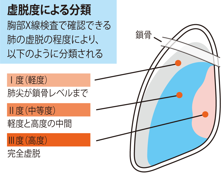 シリーズ呼吸器外科 1 気胸 中頭病院