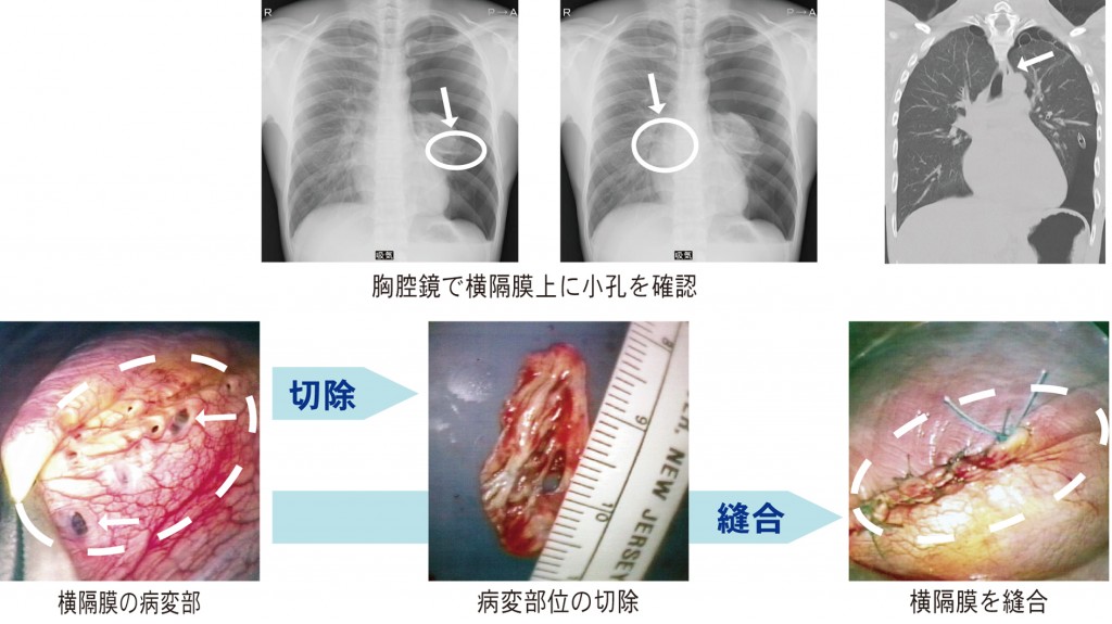 月経随伴性気胸