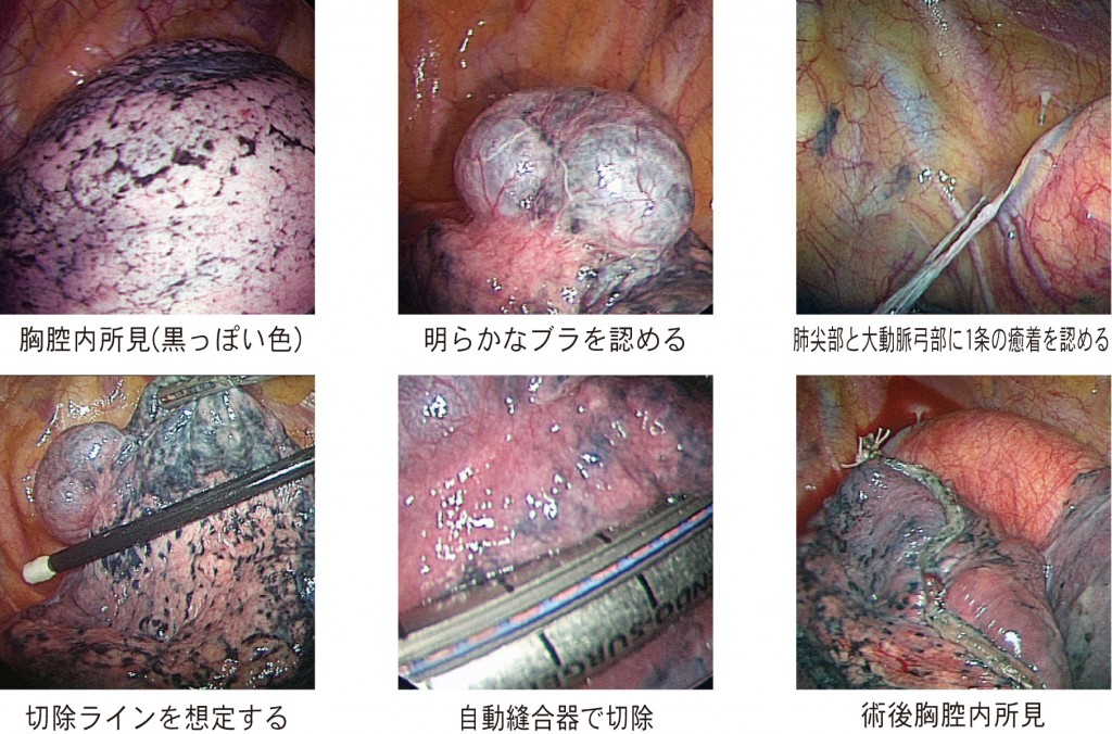 肺気腫を有する続発性気胸に対する胸腔鏡下手術